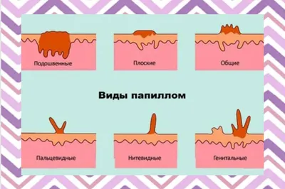 Удаление папиллом и бородавок в Москве - получите консультацию косметолога  в Face Clinic