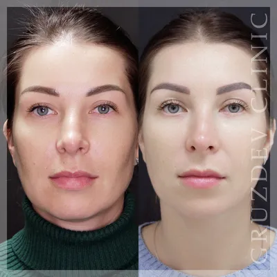 Фото \"до и после\" нитевого лифтинга: примеры подтяжки лица нитями и нитевого  армирования от врачей косметологии Груздева