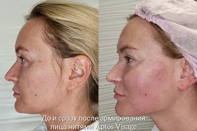 Нитевой лифтинг Aptos и контурная пластика: как это работает? | Beauty  Insider