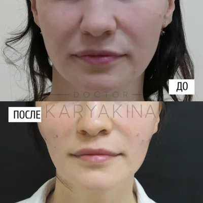 Нитевой лифтинг - подтяжка лица нитями в клинике косметологии «Градиент» в  Москве