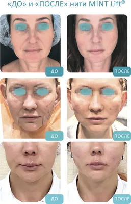 Фото \"до и после\" нитевого лифтинга: примеры подтяжки лица нитями и  нитевого армирования от врачей косметологии Груздева