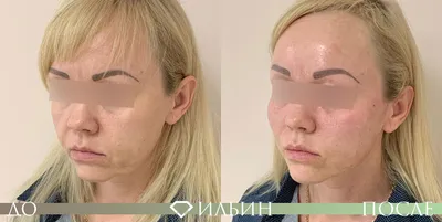 Осложнения после подтяжки нитями - Cosmetic-clinic