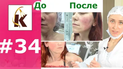 Золотые нити для лица - фото и отзывы, золотая подтяжка лица в косметологии  | Expert Clinics