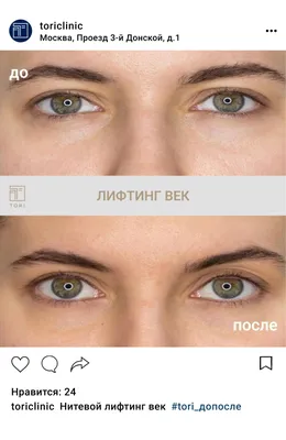 Радиес и Мезонити. Как изменилось лицо за 3 года — vzbeauty.ru