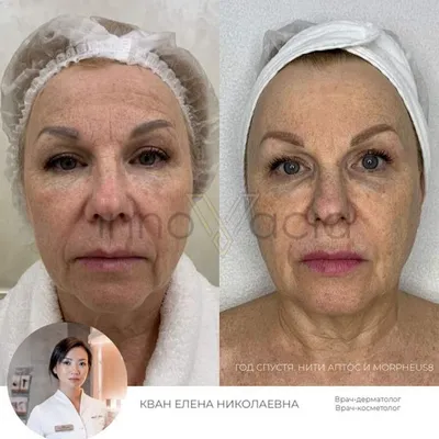 Подтяжка лица нитями: фото до и после нитевого лифтинга, отзывы о Себа |  Beauty Insider