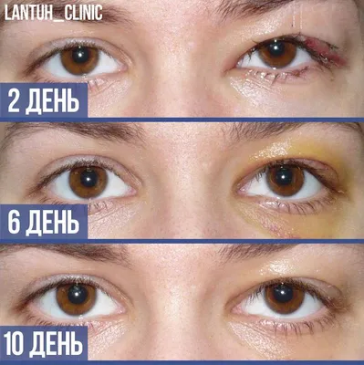 Операция Лисьи Глазки, Cat eye | Dr. Zykov