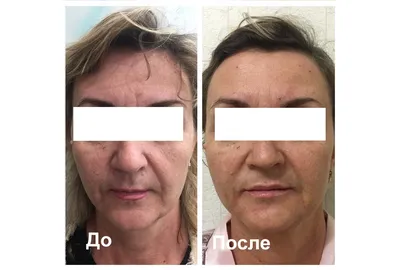 Омолаживаем область глаз липофилингом - Cosmetic-clinic