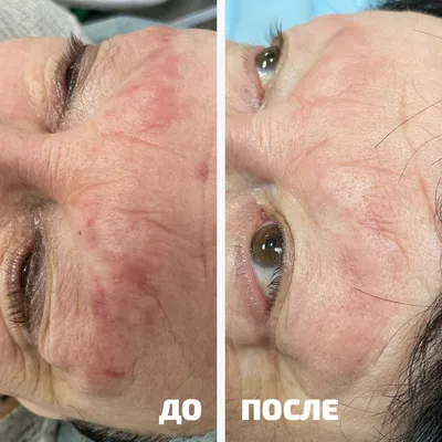 Простые правила по уходу за глазами после блефаропластики - Cosmetic-clinic