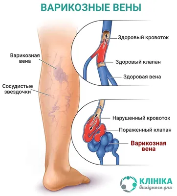 Варикоз на ногах, как избавиться? | Блог Daily Medical