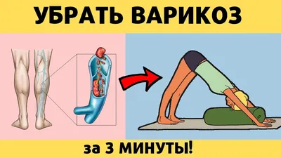 Профилактика варикоза вен на ногах