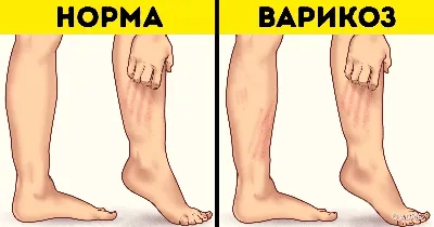 Отеки ног при варикозе - у кого чаще всего появляются отеки?