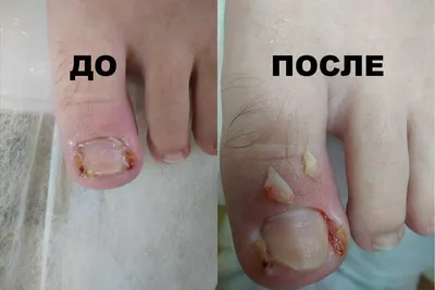Ingrown nail on a small toe 🦶 What to do? - YouTube