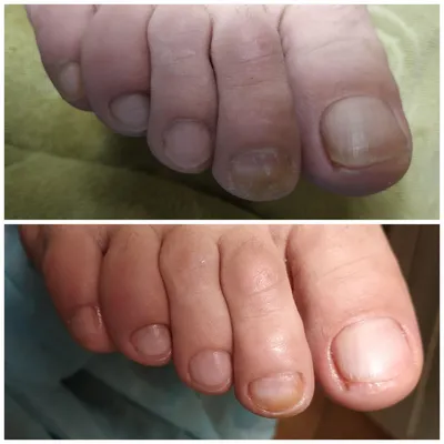 Установка скобы на ноготь в СПб, коррекция вросшего ногтя | клиника «Ева»