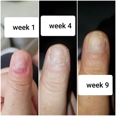 Nail-Aid - Total Cure - 9 Benefits in 1 - Walmart.com