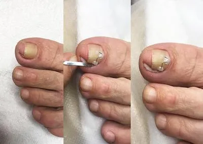 Как восстановить ногти после гель-лака. Личный опыт | Отзывы покупателей |  Косметиста