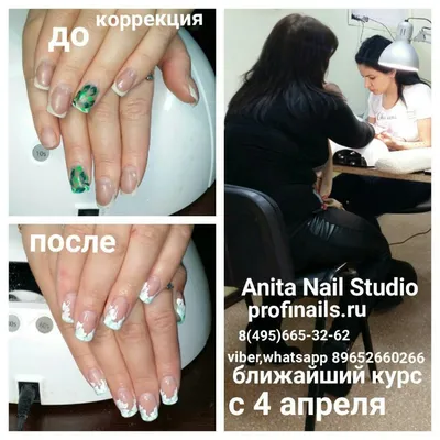 Подофикс — цена установки пластин для лечения вросшего ногтя в Москве в  «СМ-Косметология»