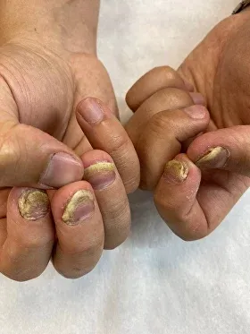 Лечение «Ковидных ногтей» в Москве в отделении дерматовенерологии клиники  ИАКИ