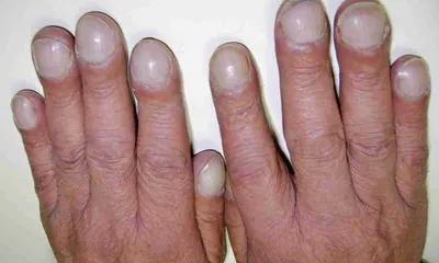 📍Ногти Гиппократа (барабанные пальцы) — патология, которую сложно спутать  с какой-либо другой, поскольку набор симптомов.. | ВКонтакте