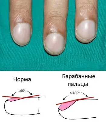 Ногти гиппократа (55 фото)