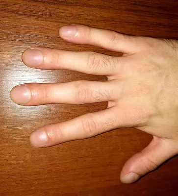 Барабанные палочки , ногти Гиппократа . Так называется эта патология  Симпто́м бараба́нных па́лочек (бараба́нные па́льцы, пальцы… | Instagram