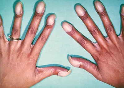 Как омолодить кожу рук и сохранить красоту ногтей: советы врача // Новости  НТВ