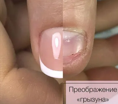 Nails of the Rodent / Transformation of Problem Nails / Feminine Manicure /  Bracing - YouTube