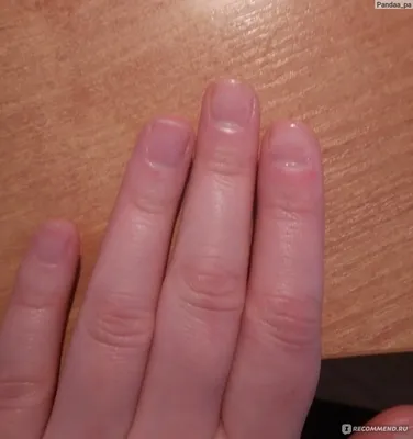 Bitten Nails Transformation | Nothing Holds On the Nails! - YouTube