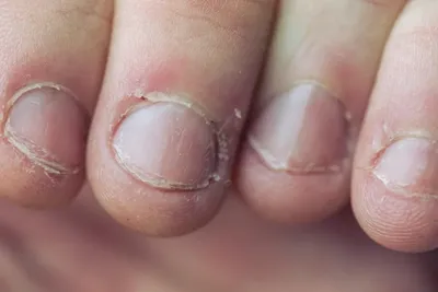 Bitten Nails Transformation | Nothing Holds On the Nails! - YouTube