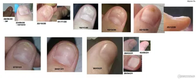 Ребристые ногти: причины, лечение и уход за ребристыми ногтями на руках