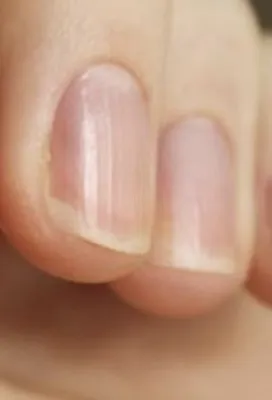 Синдром стиральной доски: что означают вмятины и бороздки на ногтях |  DOCTORPITER