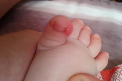 Слоятся ногти у ребёнка. — 2 ответов | форум Babyblog