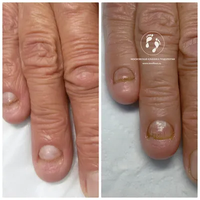 Грибковое поражение ногтей | Московская Клиника Подологии