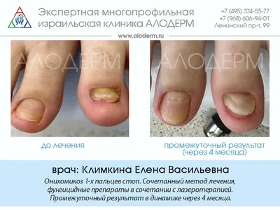 Лечение грибка ногтей лазером | Клиника АЛОДЕРМ Москва