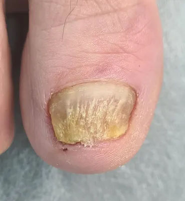 Лазерное лечение грибка ногтей - Natura Termo SPA