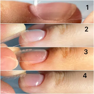 Почему болят ногти после наращивания: причины и способы решить проблему