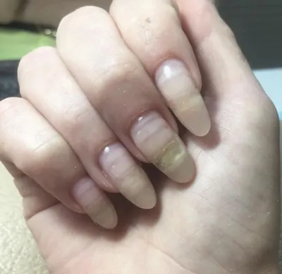 Как выглядит аллергия на гель-лак: девушка показала ногти, которые  пострадали после домашнего маникюра