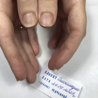 Повреждение ногтя после использования шеллака Стоковое Фото - изображение  насчитывающей взорвать, маникюр: 153917006