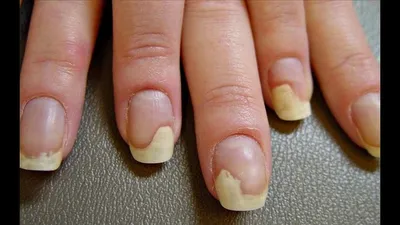 Причины ломкости ногтей и секреты ухода для укрепления ногтевой пластины
