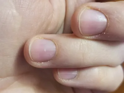 Ногти при железодефицитной анемии | Пикабу