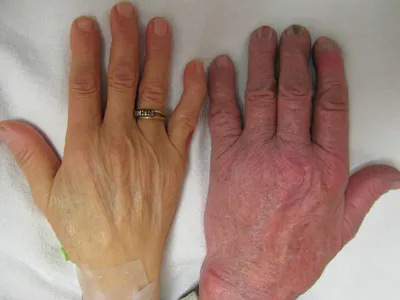 Ломкость ногтей на руках – причины, симптомы, лечение и профилактика