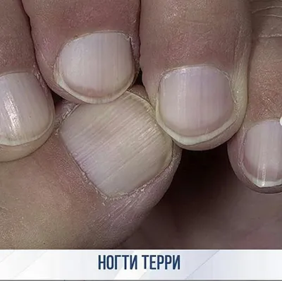 ACI Nail School - О чём говорят ногти?🤨 Да, ногтевые пластины могут  рассказать о многом ☝🏻 ⠀ Что мы знаем о поперечных бороздах? 😯 Часто  встречаются такие нарушения после механических воздействий (