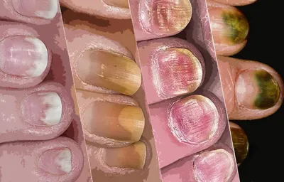 TUFI profi🪻Матеріали для манікюру on Instagram: \"О чём говорят ногти?🤨  Да, ногтевые пластины могут рассказать о многом ☝🏻 ⠀ Что мы знаем о  поперечных бороздах? 😯 Часто встречаются такие нарушения после механических