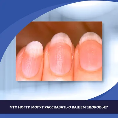 Лечение ногтей СПб. Лечение болезней ногтей в Nail Clinic