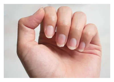 Ногти - отражение здоровья. Как они меняются при заболеваниях | Патолог |  Дзен