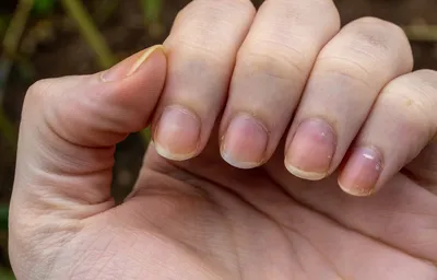 https://globalfashion.ru/blog/id333-the-11-most-effective-home-remedies-for-nail-psoriasis-according-to-derms