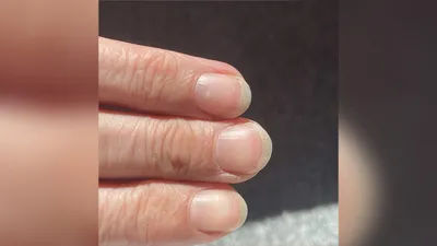 Гастроэнтеролог Слюняева: Ногти Терри могут указывать на заболевания печени