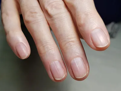 О каких заболеваниях говорят ногти на руках и ногах, как по цвету ногтей  определить болезнь - Чемпионат