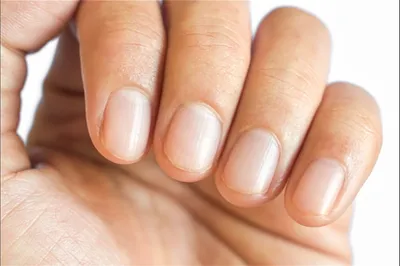 Белые пятна на ногтях у взрослых