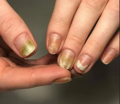 Ногти болезни организма по ногтям - 59 фото