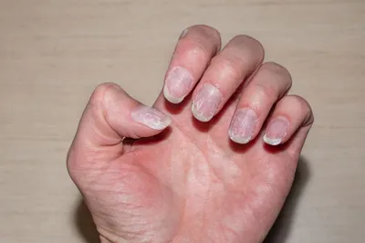 Диагностика здоровья по ногтям. Что говорят ногти о вашем состоянии? |  ВКонтакте